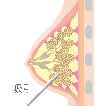 乳房脂肪吸引法