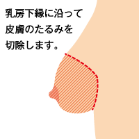 乳房及び乳腺切除、皮膚切除+乳輪移植イメージ1