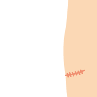 乳房及び乳腺切除、皮膚切除+乳輪移植イメージ4